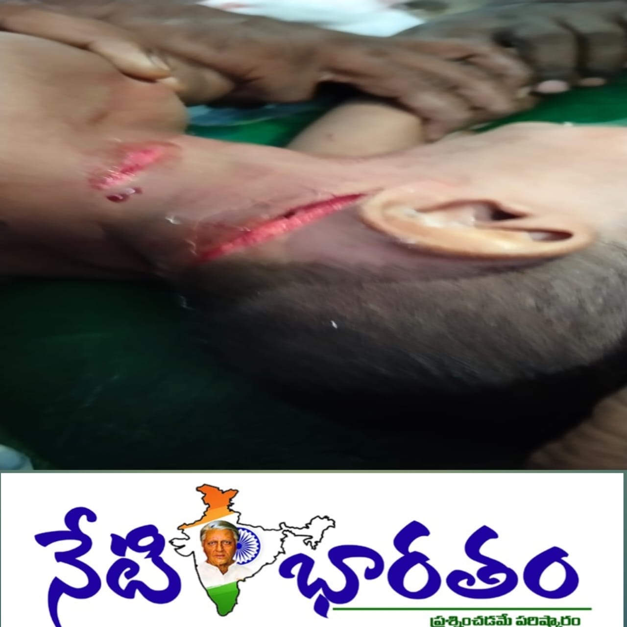కమిషన్ల కక్కుర్తి వల్లే… కుక్కల దాడులు.